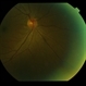 Normal Eye Normal Eye